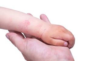 Аллергическая сыпь у детей: причины и 8 факторов риска, виды и 13 методов лечения, обзор препаратов
