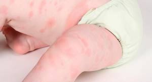 Аллергическая сыпь у детей: причины и 8 факторов риска, виды и 13 методов лечения, обзор препаратов