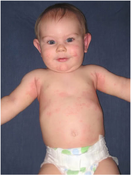 Аллергия на глютен у грудничка и детей постарше: 6 методов диагностики и 4 варианта лечения, правильная диета