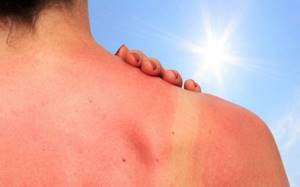 Аллергия на солнце у детей: 5 факторов и 4 признака, первая помощь
