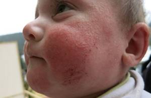 Аллергия на солнце у детей: 5 факторов и 4 признака, первая помощь