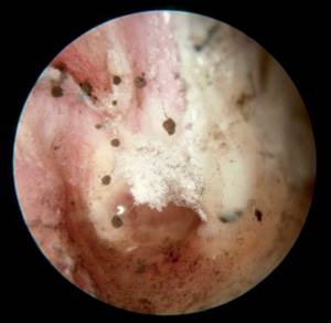 Плесневый грибок в ушах — отомикоз, фото пример.