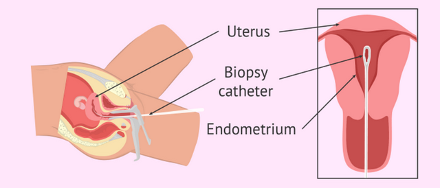 Что такое биопсия эндометрия и какие виды бывают