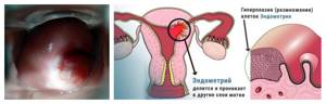 Что такое гиперплазия шейки матки и как это лечить