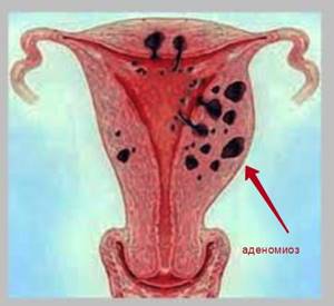Что такое миома матки в сочетании с аденомиозом и как их лечить