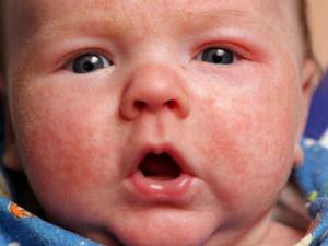 Цветение новорожденных: причины акне, как отличить от аллергии, лечение