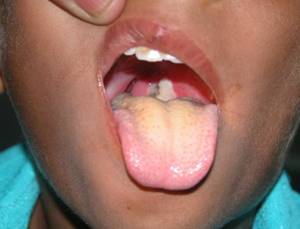 Дифтерия: симптомы у детей и 3 направления профилактики