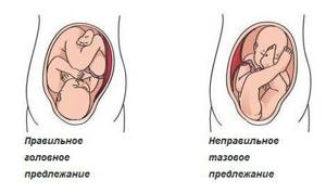 Дисплазия тазобедренных суставов у детей: лечение у новорожденных, грудничков, детей до года