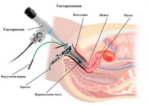 Как проводится гистерорезектоскопия