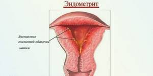 Как выявить и вылечить хронический эндометрит