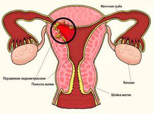 Какие патологии эндометрия бывают у женщин