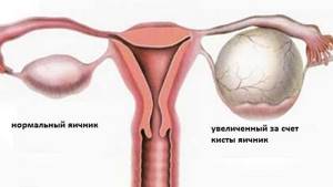 Какими могут быть причины увеличения яичника у женщин и как это лечить