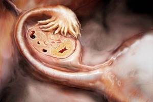 Какими могут быть причины увеличения яичника у женщин и как это лечить