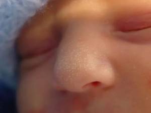 Кожные заболевания у новорожденных: 7 проявлений, что делать, уход за кожей