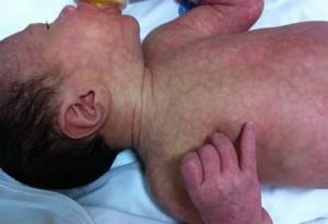 Кожные заболевания у новорожденных: 7 проявлений, что делать, уход за кожей