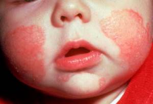 Мазь и крем от аллергии (атопическом дерматите) на коже для детей: виды, обзор лучших препаратов