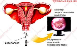 Особенности выскабливания полости матки при гиперплазии эндометрия