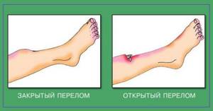 Перелом у ребенка: руки, ноги (стопы, голени), черепа, со смещением и без, как отличить от ушиба