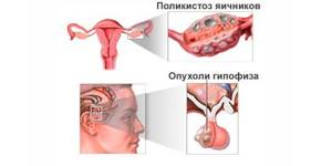 Причины появления аменореи у женщин