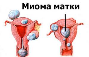 Причины появления кровотечений между менструациями