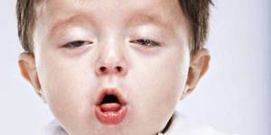 Сильный кашель у ребенка: что делать, 9 причин кашля, чем лечить — советы педиатра