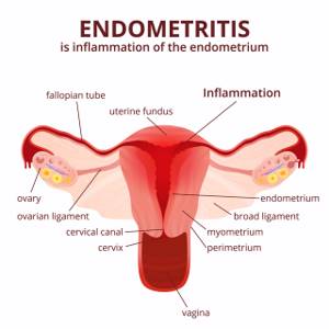 Симптомы и лечение острого эндометрита