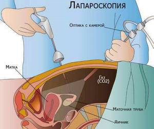 Симптомы и лечение параовариальной кисты яичника