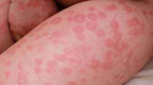 Температура при аллергии у детей: 5 причин, советы врача родителям