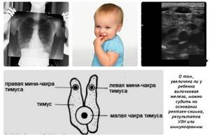 Тимомегалия у детей: 16 причин, 3 вида, 4 группы симптомов, 2 подхода к лечению