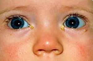 У ребенка гноятся глаза: 3 вероятных причины-заболевания, методы лечения и профилактика