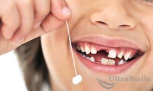 Удаление молочных зубов в домашних условиях и у врача: 3 показания, как удалить, последствия
