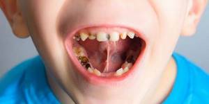 Удаление молочных зубов в домашних условиях и у врача: 3 показания, как удалить, последствия