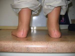 Виды плоскостопия у детей: 4 разновидности и рекомендации от педиатра