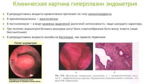 Все о гиперплазии эндометрия: норма и патология