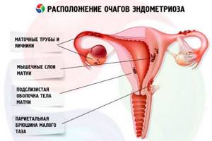 Все об эндометриозе шейки матки