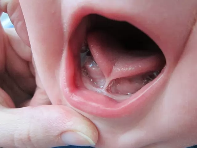 Белый налет на языке у ребенка: 3 основных причины и 3 способа очистить язык грудничку