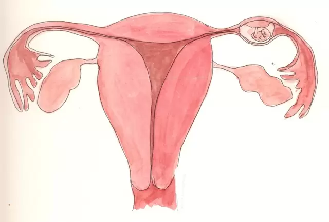 Бывают ли месячные при внематочной беременности и какие у нее признаки
