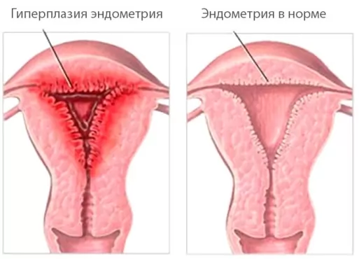 Фазы полиферации эндометрия: норма и отклонения