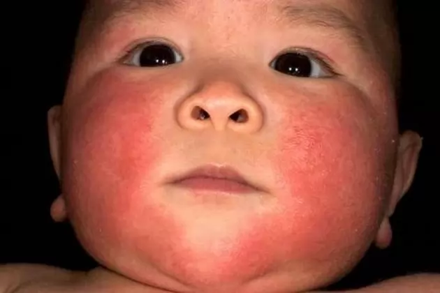 Как отличить потницу от аллергии у грудничка: 13 отличий, симптомы, советы по уходу за кожей детей