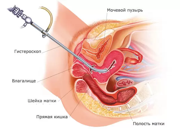 Как проводится полипэктомия цервикального канала