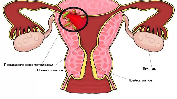 Как вылечить хронический эндометриоз и каковы его симптомы
