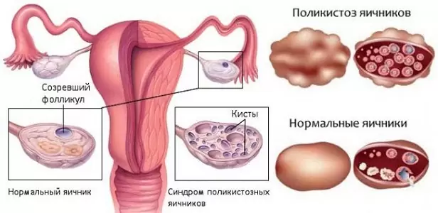 Нарушение менструального цикла у подростков: главные причины и способы лечения