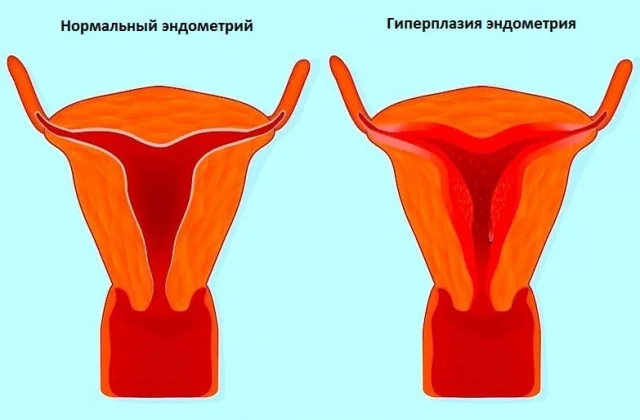 Особенности лечения дюфастоном и норколутом при гиперплазии эндометрия