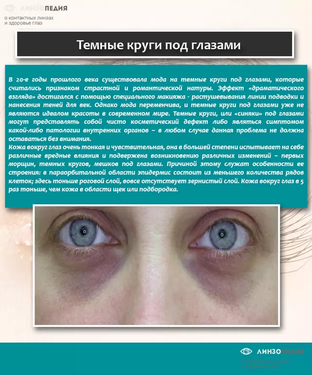 Синяки под глазами у ребенка: 12 возможных причин, методы лечения и профилактики