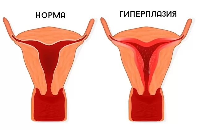 Все о железисто-фиброзным полипе эндометрия