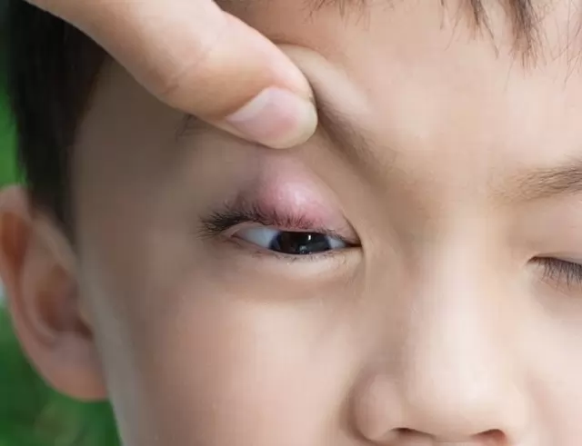Ячмень на глазу у ребенка: 8 причин появления, 3 главных симптома, 7 правил лечения и 6 мер профилактики