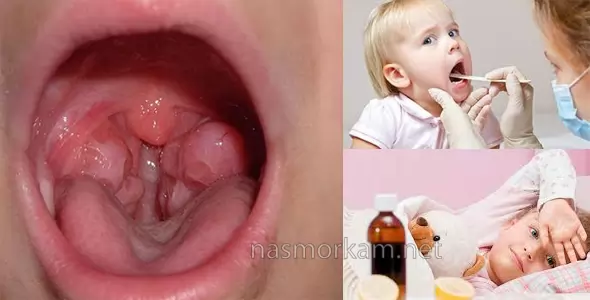 Затяжной насморк у ребёнка: как лечить и 3 правила закапывания капель в нос